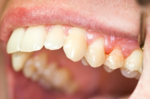 Symptoms of Gum Disease